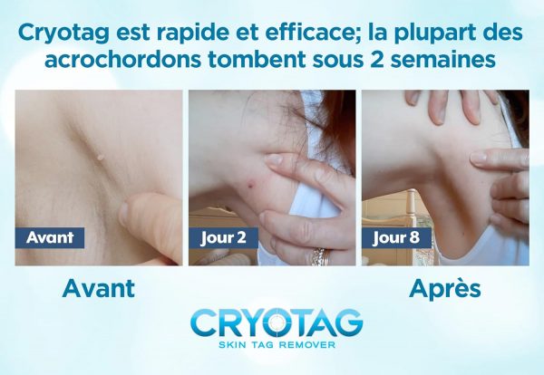 Cryotag Skin Tag Remover